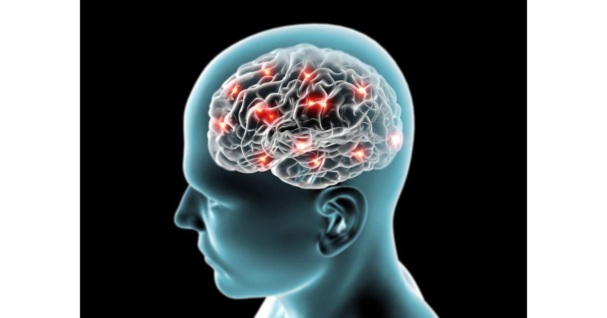 epilepsy1