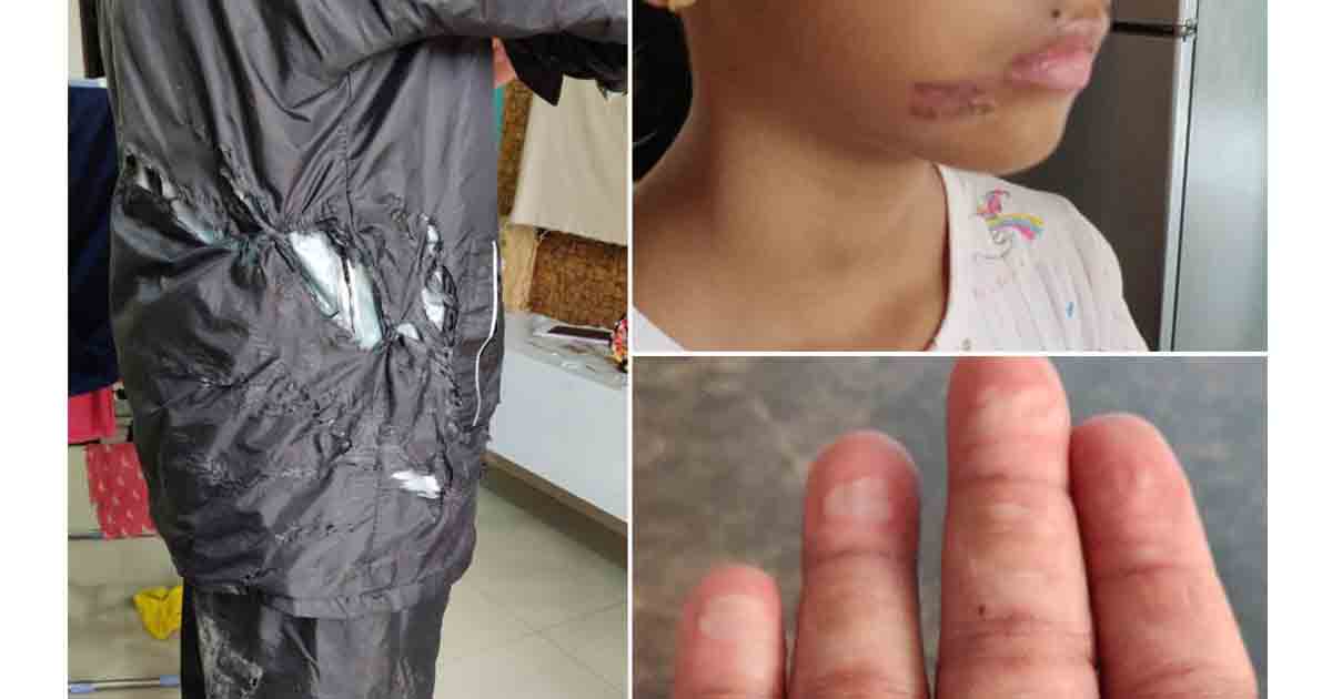 MSEDCL Cable Causes Burn Injuries to 12 yr old Pimple Saudagar resident and her father-1