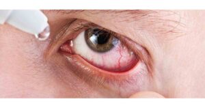 Enough stock available to battle Conjunctivitis, clarifies FDA Pune