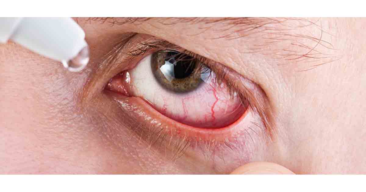 Enough stock available to battle Conjunctivitis, clarifies FDA Pune
