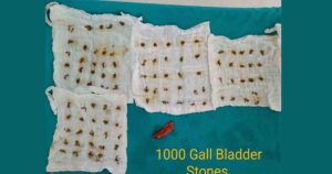 Over 1000 Stones Successfully Removed From 30 Year-Old Female’s Gallbladder3