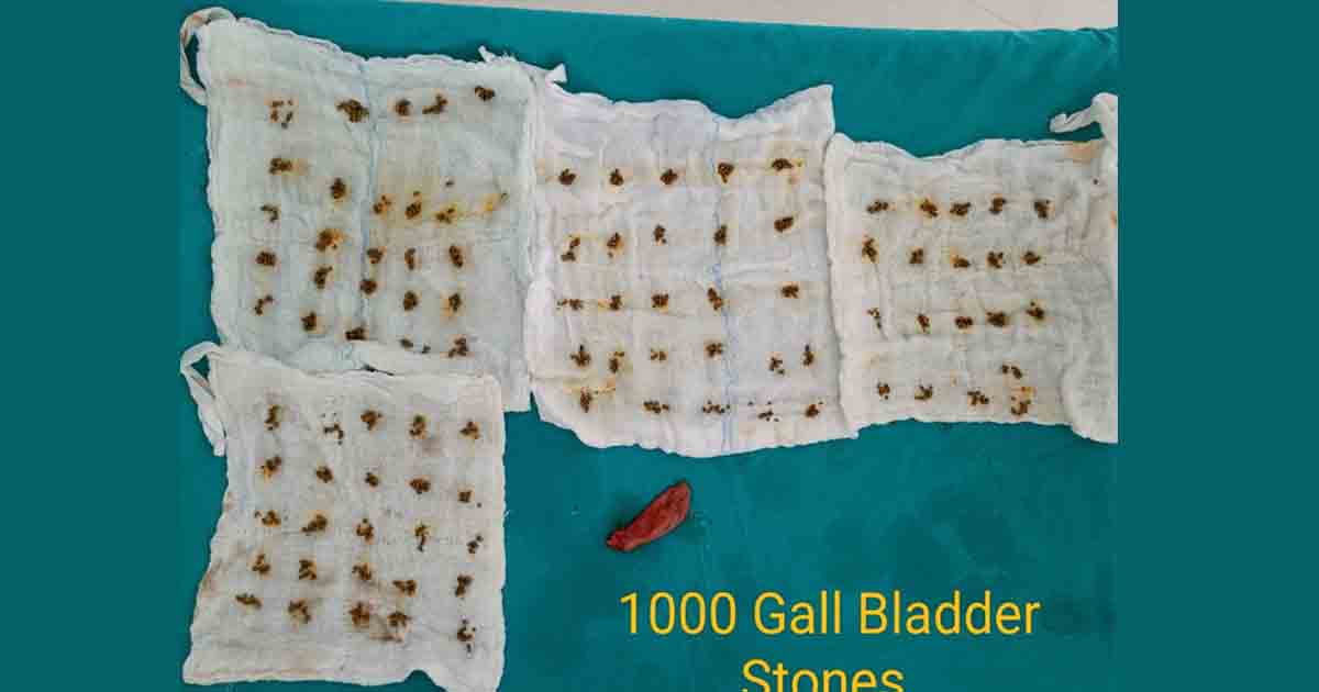 Over 1000 Stones Successfully Removed From 30 Year-Old Female’s Gallbladder3