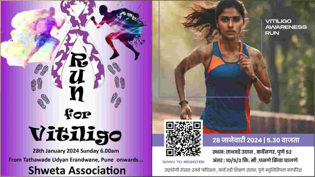 Pune : Run For Vitiligo Marathon to be held on January 28. Details here.