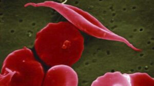 Akums launches affordable sickle cell anaemia drug Priced at Just 1% of Global Standard