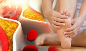Heart Health At Risk When High Cholesterol Levels Affect The Legs and Feet This Way
