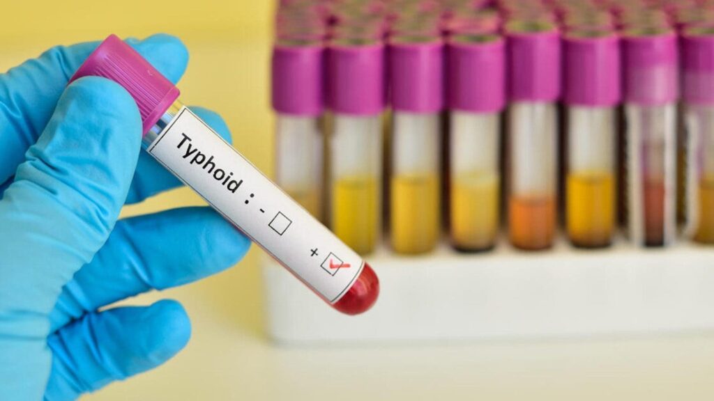 Pune: Typhoid Outbreak in Sadanand nagar Prompts PMC Action