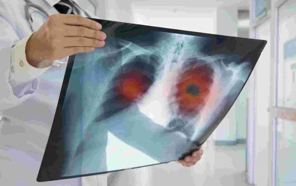 Non-Smokers in India Face High Risk of Lung Cancer, Study Reveals