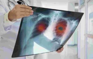 Non-Smokers in India Face High Risk of Lung Cancer, Study Reveals
