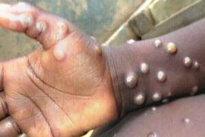 Pune Municipal Corporation Intensifies Mpox Surveillance And Testing