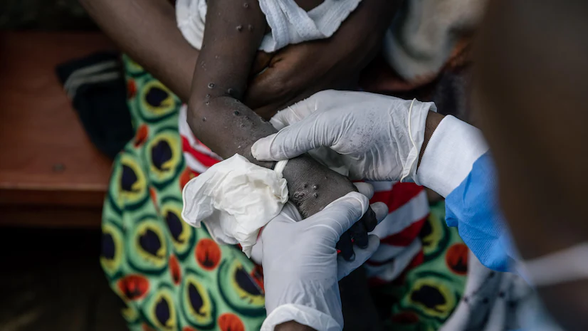 Bengaluru Airport sets up Mpox testing stations; 21-day quarantine for positive patients