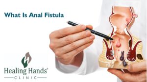 What you need to know about anal fistula & its treatment