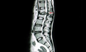 Pune Hospital Treats Rare Spinal Tuberculosis Of 13-Year-Old Girl