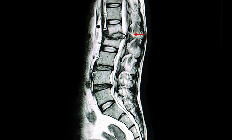 Pune Hospital Treats Rare Spinal Tuberculosis Of 13-Year-Old Girl