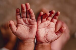 Coxsackie Virus Outbreak Hits Mumbai, Doctors Sound Alarm