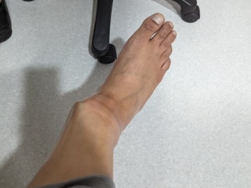 IndiGo Passenger Still Unable to Walk After Fall on Ramp at Delhi Airport Three Months Ago