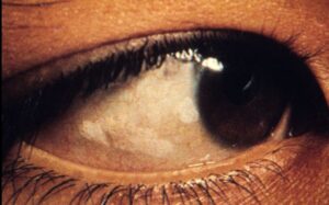 8-Year-Old Goes Permanently Blind Due to Fussy Eating and Poor Diet Choices, Doctors Warn of Nutritional Risks