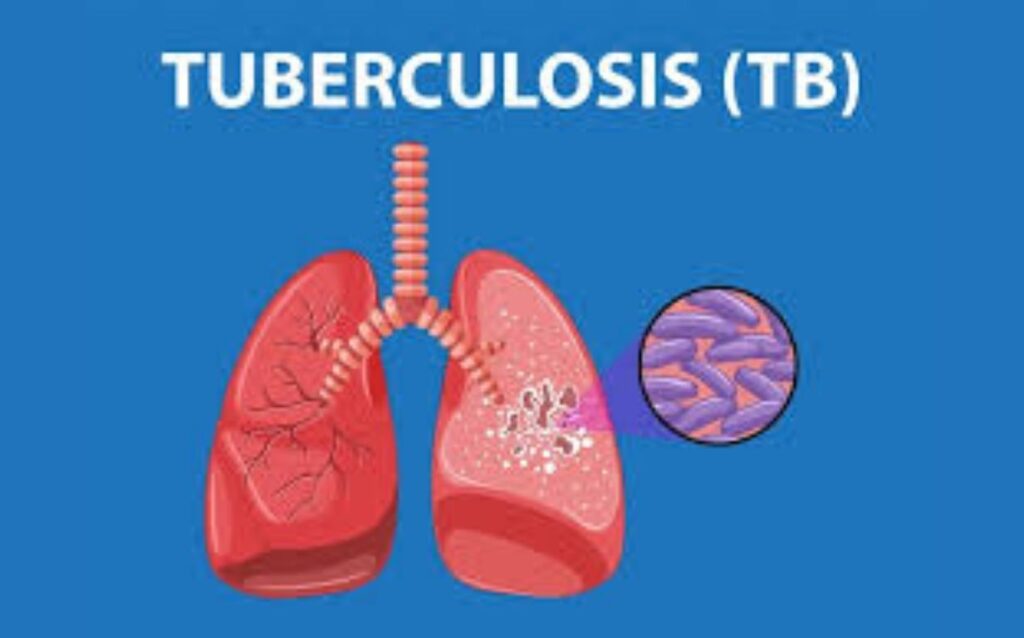 Maharashtra Reports 24,287 New TB Cases Under National Elimination Campaign