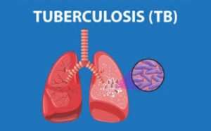 Maharashtra Reports 24,287 New TB Cases Under National Elimination Campaign
