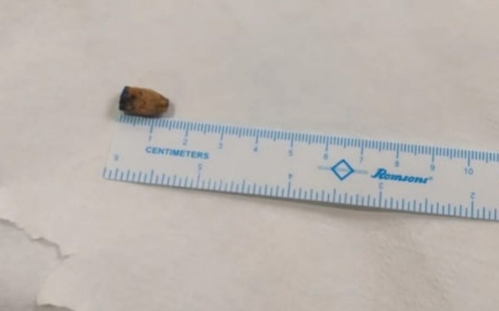 Hyderabad Doctors Remove Pen Cap from Man’s Lung After 21 Years, Saving Him from Severe Damage