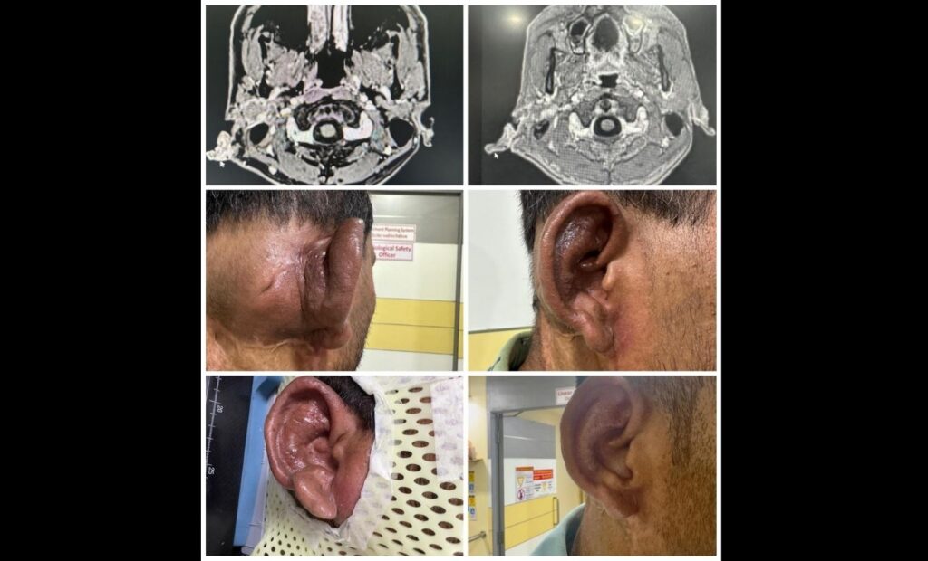 Radiosurgery Technique Successfully Treats Complex Ear AVM In Pune Patient