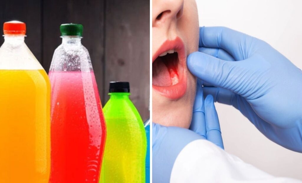 Sugary Drinks Increase Oral Cancer Risk Fivefold – More Harmful Than Alcohol, Experts Warn