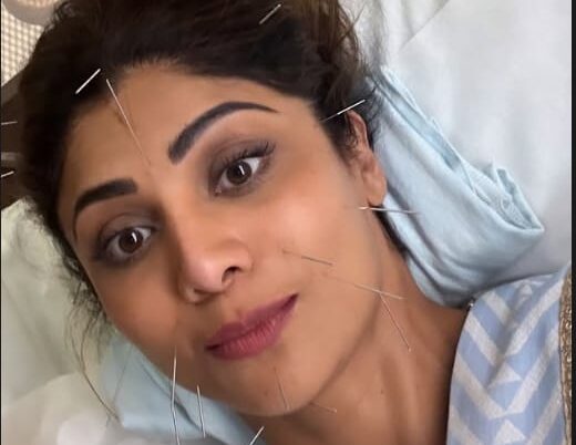 Shilpa Shetty Undergoes Acupuncture for Sinus Relief, Shares Needle-Adorned Photo