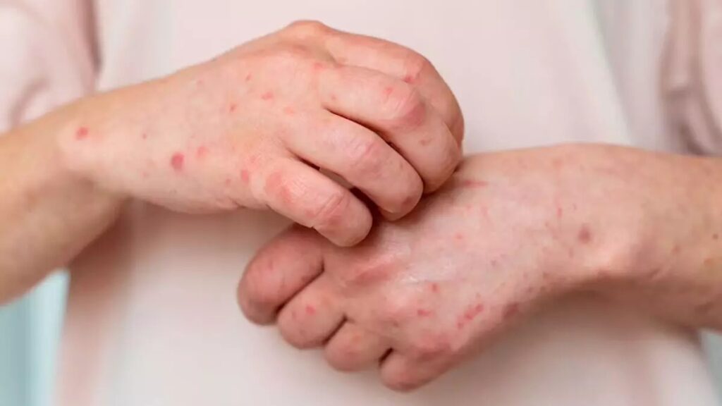 Lack Of Awareness About Shingles Among Indians Over 50 Poses Health RiskÂ