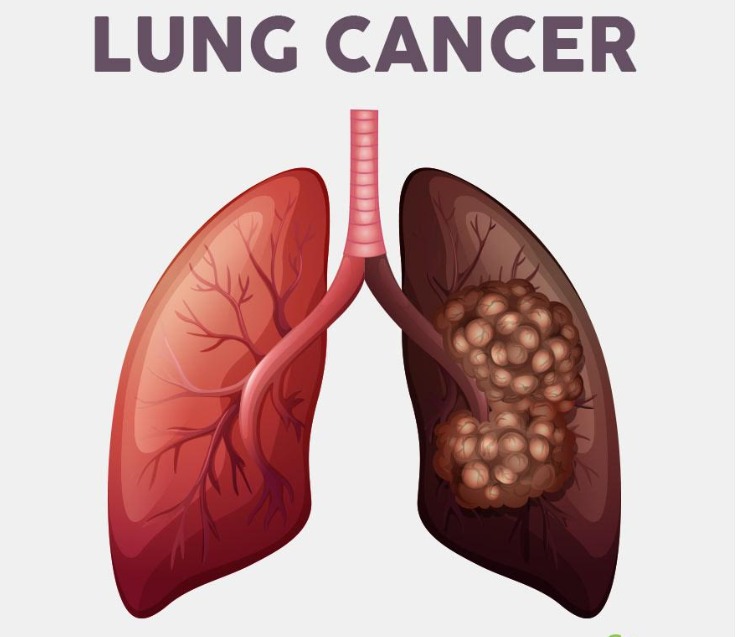 cancer