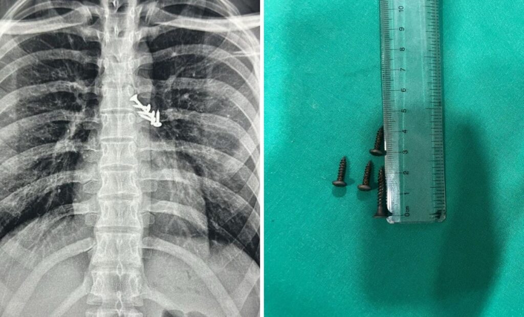 Pune: Life Saved After Pimpri Surgeons Remove Seven Nails Lodged In Electrician’s Lungs And Stomach