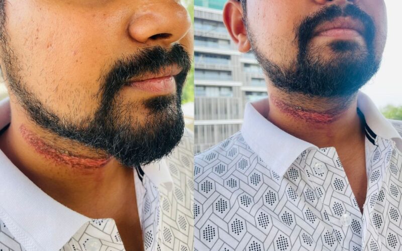 Pune: Youth Injured After Low-Hanging Wire Strikes Neck On Sinhagad Road