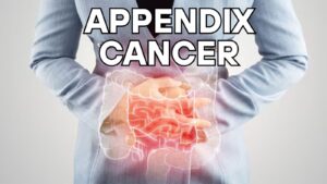 Appendix Cancer Increasing in Millennials and Gen Z: Know the Signs