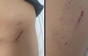 Pune: Baner Resident Files Police Complaint After 9 Year Old Attacked By Aggressive Pet Dog In Society Play Area