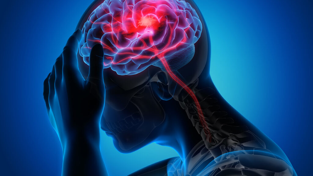 Strokes Can Strike at Any Age