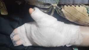 Mumbai: 8-Year-Old’s Hand Burnt by Tuition Teacher Over ‘Bad Handwriting’, Locals Allege Pattern of Abuse