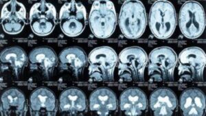 This Simple Blood Test Could Reveal Your Alzheimer’s Risk Decades Before Symptoms Start