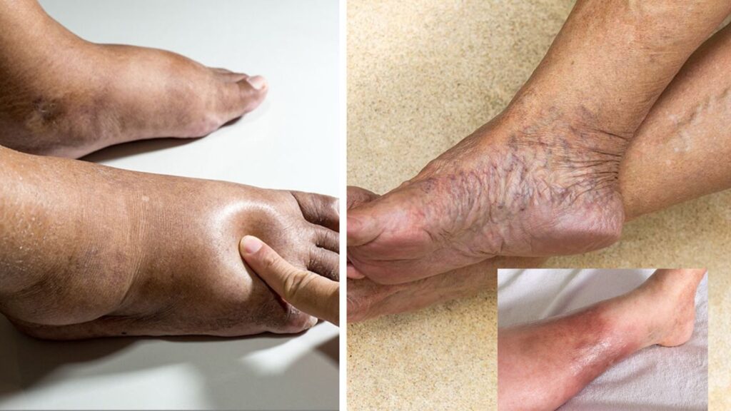 6 Early Signs of Liver Damage That Appear in Your Legs — Ignoring Them Can Lead to Serious Health Issues