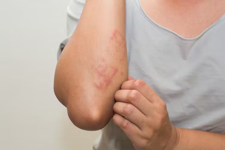 How to Protect Your Skin from Rashes, Acne, and Infections During Monsoon
