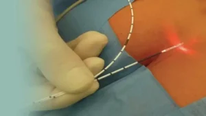 Laser To Cure Pilonidal Sinus