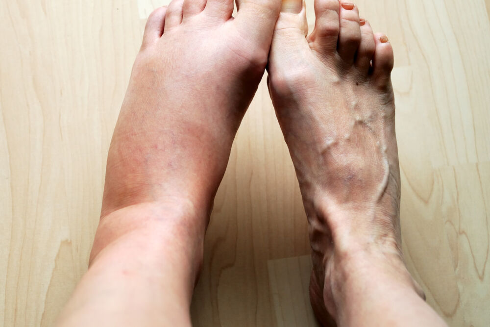 Is Ankle Swelling a Sign of Heart Trouble? What You Need to Know