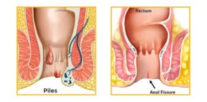 Ways to distinguish between piles and fissure