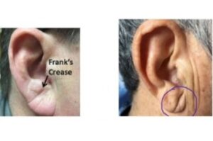 Frank’s Sign: Can an Earlobe Crease Predict a Heart Attack or Stroke?