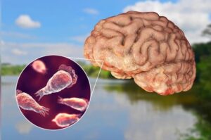 Kerala Brain Eating Amoeba, Naegleria Fowleri Infection, Kozhikode Health Alert, Rare Disease India, Kerala Medical News, Amoeba Infection Death Case