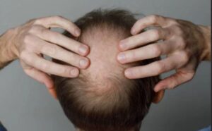 New Study Reveals This Drug Can Boost Hair Density by 20% in Men With Hair Loss: Here’s Everything You Need To Know