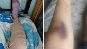 Pune: Wanowrie Woman Injured in Accident, Residents Blame Poor Road Work Near Ganga Satellite
