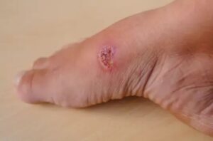 The Truth About Skin Ulcers: Causes, Early Signs, and Easy Prevention Tips