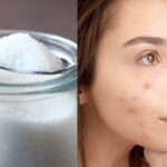 Is Sugar the Real Reason Behind Your Skin’s Breakouts, Inflammation, and Early Wrinkles?
