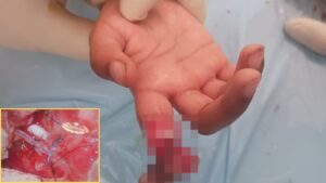Pune: 5 Year Old Girl Undergoes Successful Finger Replantation Surgery After Stray Dog Attack