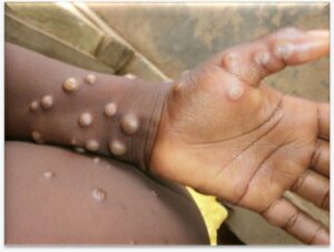 Maharashtra: First Monkeypox Case Reported In Dhule; Patient Recently Returned From Saudi Arabia