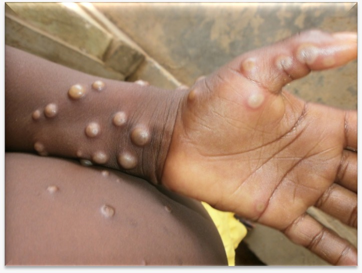 Maharashtra: First Monkeypox Case Reported In Dhule; Patient Recently Returned From Saudi Arabia