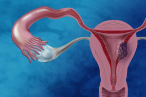 Burning Belly Fat May Fuel Aggressive Uterine Cancer in Women, New Study Finds